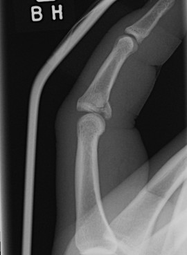Finger Dorsal Dislocation Extension Blocking Splint